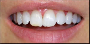Central Incisor Before