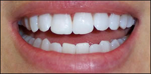 Central Incisor After