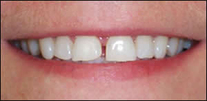 Maxillary Diastema Closure - 2 Before