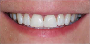 Maxillary Diastema Closure - 2 After