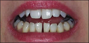 Mandibular Diastema Closure Before