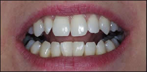 Mandibular Diastema Closure After
