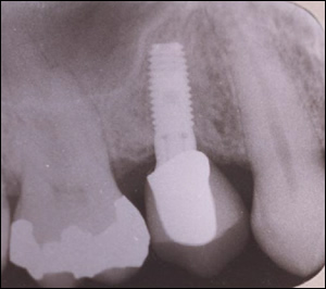 Sinus Augmentation - 1 Figure 3 Sinus Augmentation - 1 Figure 3