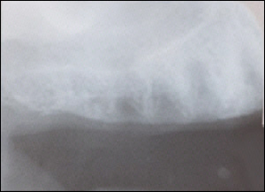 Sinus Augmentation - 2 Figure 1 Sinus Augmentation - 2 Figure 1