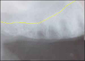 Sinus Augmentation - 2 Figure 2 Sinus Augmentation - 2 Figure 2