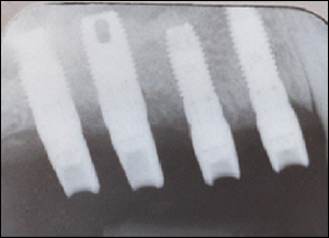 Sinus Augmentation - 2 Figure 3 Sinus Augmentation - 2 Figure 3