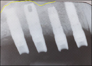 Sinus Augmentation - 2 Figure 4 Sinus Augmentation - 2 Figure 4