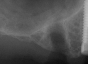 Sinus Augmentation - 3 Figure 1 Sinus Augmentation - 3 Figure 1