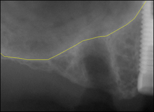 Sinus Augmentation - 3 Figure 2 Sinus Augmentation - 3 Figure 2