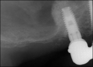 Sinus Augmentation - 3 Figure 3 Sinus Augmentation - 3 Figure 3