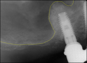 Sinus Augmentation - 3 Figure 4 Sinus Augmentation - 3 Figure 4