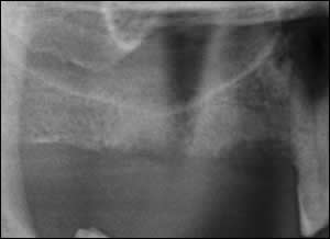 Bone Augmentation Bone Augmentation