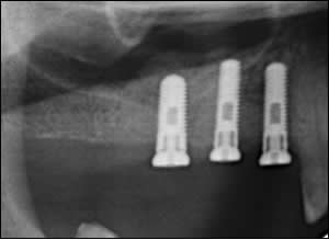 bone augmentation bone augmentation