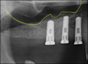 bone augmentation bone augmentation