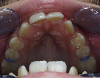 Rapid Palatial Expansion Rapid Palatial Expansion