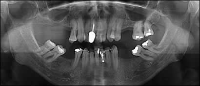 implant implant
