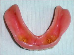 natural overdenture natural overdenture