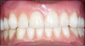 natural overdenture natural overdenture
