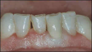 incisor incisor