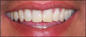 Whitening-1