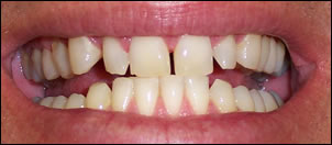 Whitening-1