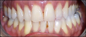 Whitening-1